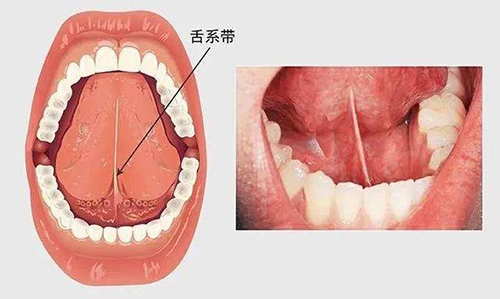 舌系带短.jpeg